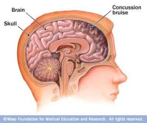concussion bruise on frontal area