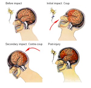 impact injuries on brain cross cuts