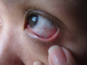 eye infection