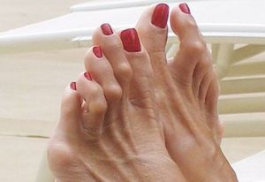 hammertoes