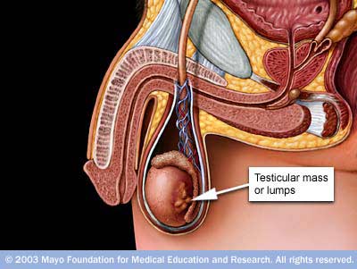 inguinal surgery for testicular cancer